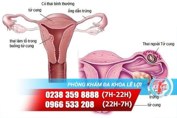 thai-ngoai-tu-cung