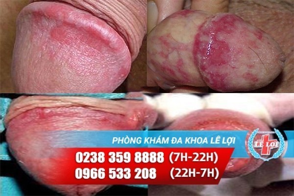 hinh-anh-bieu-hien-viem-bao-quy-dau-do-nam-candida-2