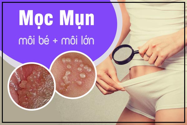 het-suc-luu-y-tinh-trang-moc-mun-moi-be-moi-lon-1