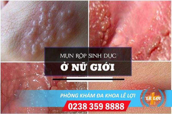 nguyen-nhan-va-cach-dieu-tri-hot-le-bi-ngua-rat-2