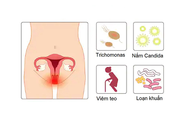 Nhiễm khuẩn nhiễm trùng âm đạo là gì?