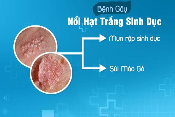 tinh-trang-noi-hat-trang-sinh-duc-la-benh-gi-1